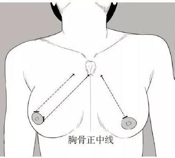 江油首例完全经腔镜甲状腺手术在“江医”成功开展