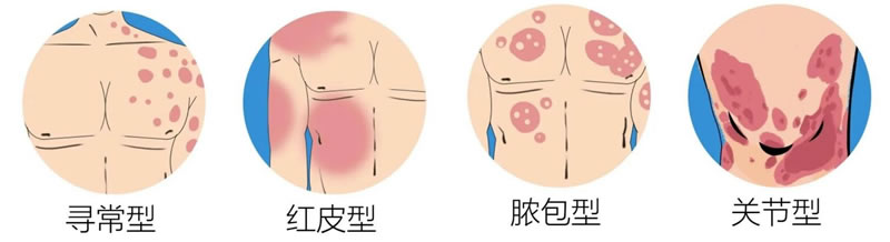 银屑病患者的福音来了！我院被授予“银屑病专病门诊”！