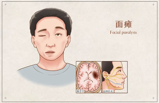 嘴歪、眼斜、流口水……可能是面瘫！该咋办？（附康复训练视频）