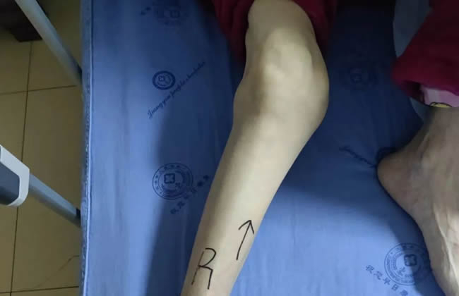 外翻人工膝关节置换术，让多年K形腿老年患者“重获新生”!
